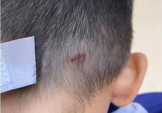孩子打闹导致头部受伤,家长失去理智掌掴对方,如今后续详细公布_教育