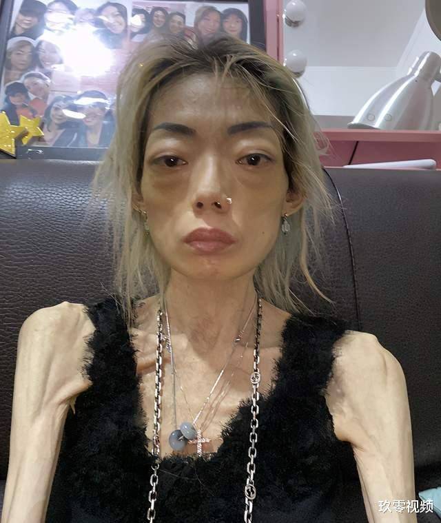 不仅昔日美丽的容颜不复存在,健康的身体也没有了,变成了"空壳怪物".