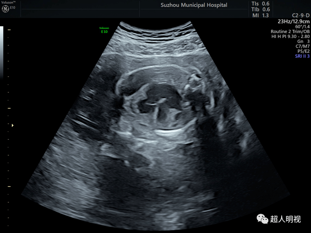 胎儿透明隔腔超声检查专家共识_Email