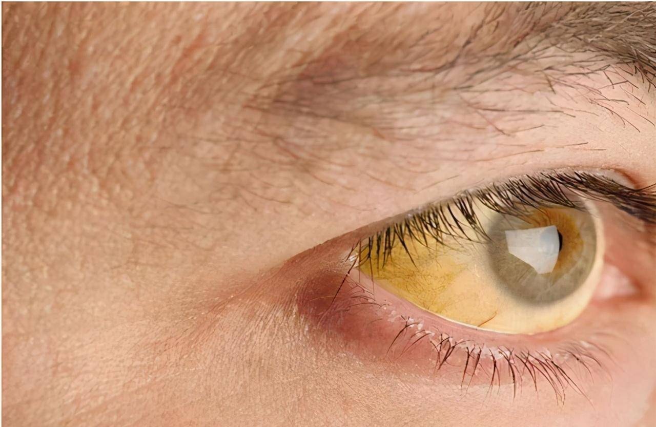 肝不好,眼睛会有暗示,养护肝脏,常喝一水,多食三绿,做好一事_养肝