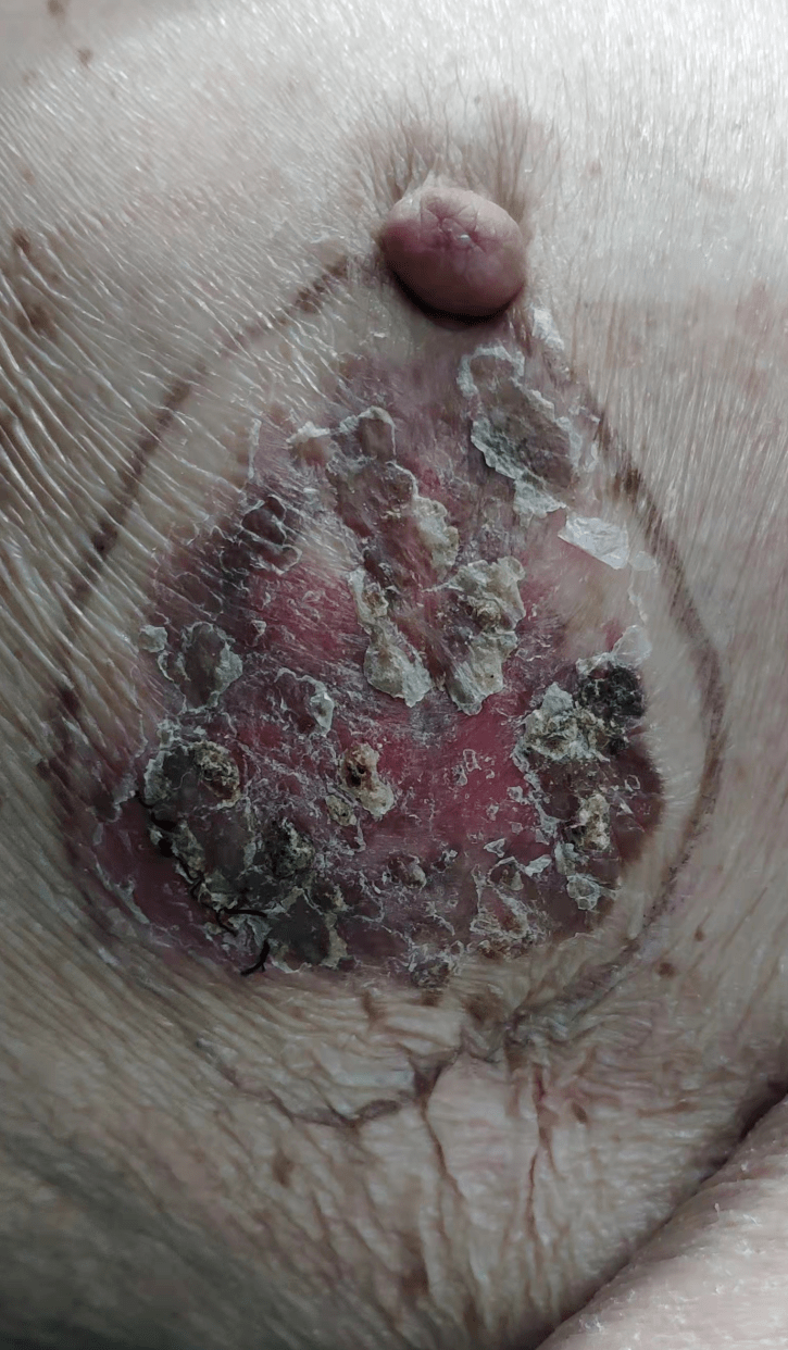 困扰七旬老人多年的鲍温病,终于得救了!_治疗_女患者_部位