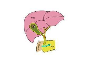 胆囊癌的演变史!