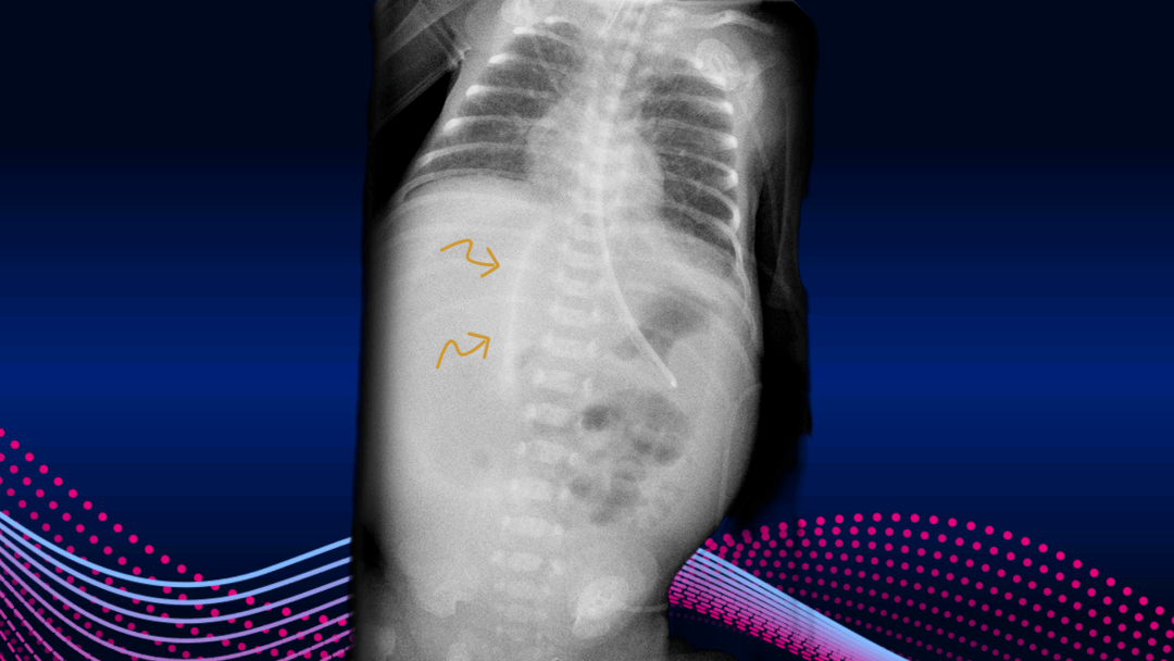 ",其中,脐正中韧带和镰状韧带如同足球正中的缝合线,又称为镰状韧带征