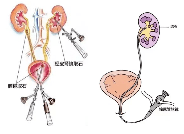 输尿管软镜取石术流程图片