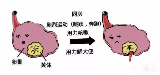 这种肚子疼可能要命,女性一定要知道,并做好预防(不是痛经)