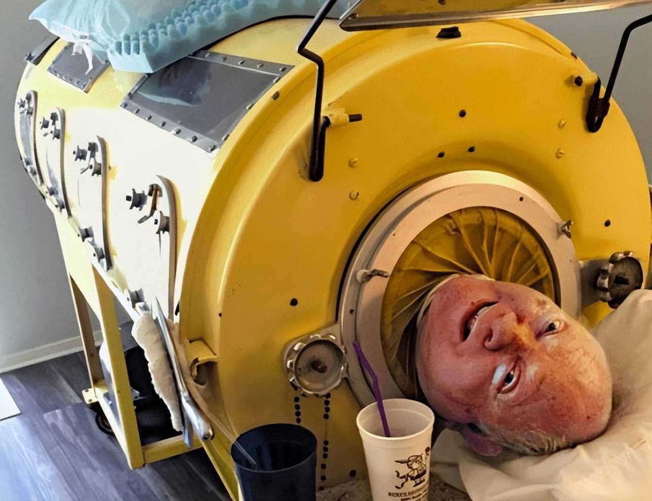 铁桶人:活着躺在棺材里,住进铁桶50年,停电意味着生命终结_保罗_患者