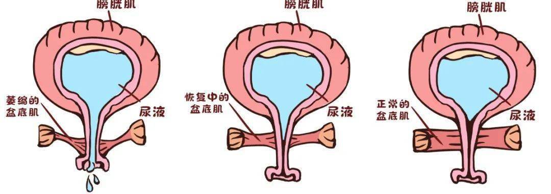 膀胱膨隆图片图片