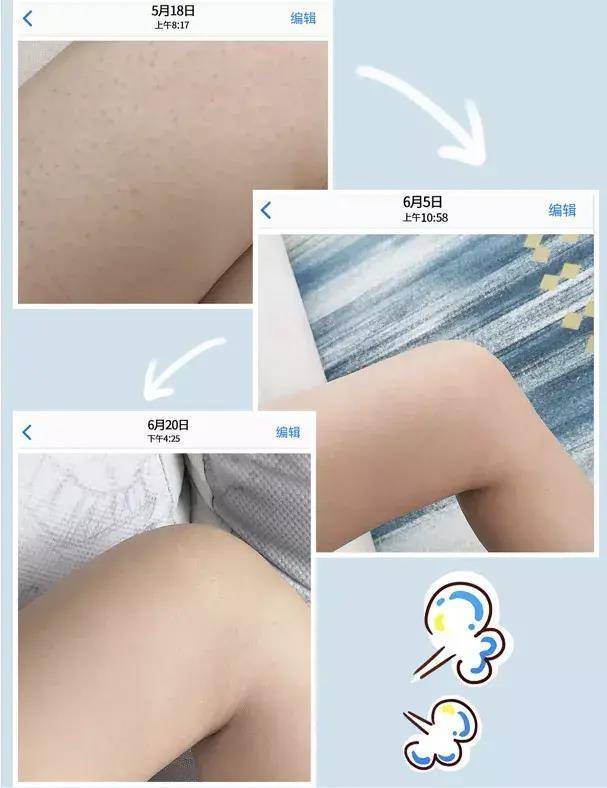 打预防针产生鸡皮肤(鸡抓着脸要打预防针吗) 打预防针产生鸡皮肤(鸡抓着脸要打预防针吗)