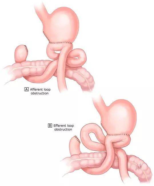 胃输入袢和输出袢图解图片