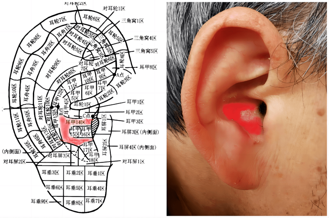 耳穴气管:位于耳甲腔,在心区与外耳门之间,即耳甲16区.