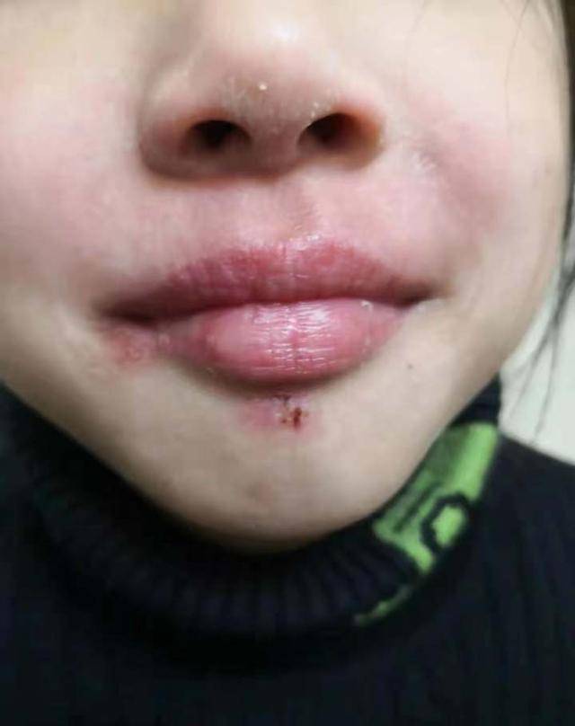 进入冬季,很多人常不好意思地问:这里涂点啥才能消肿?_嘴唇_小沈_唇膏
