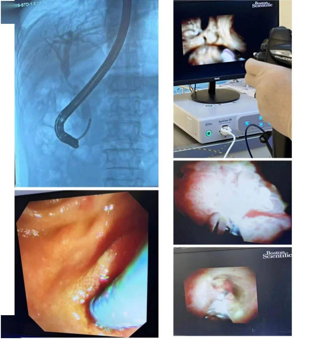 小鏡子大作用—消化內科成功實施首例spy glass膽道鏡檢查_患者_直視