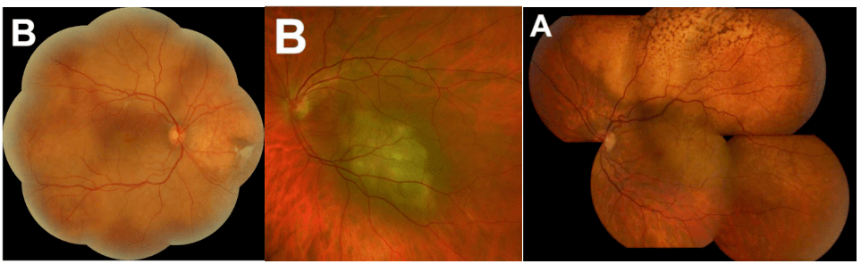 脉络膜转移癌的眼底表现cm的超声特征:扁平或略呈穹窿状的肿块,具有