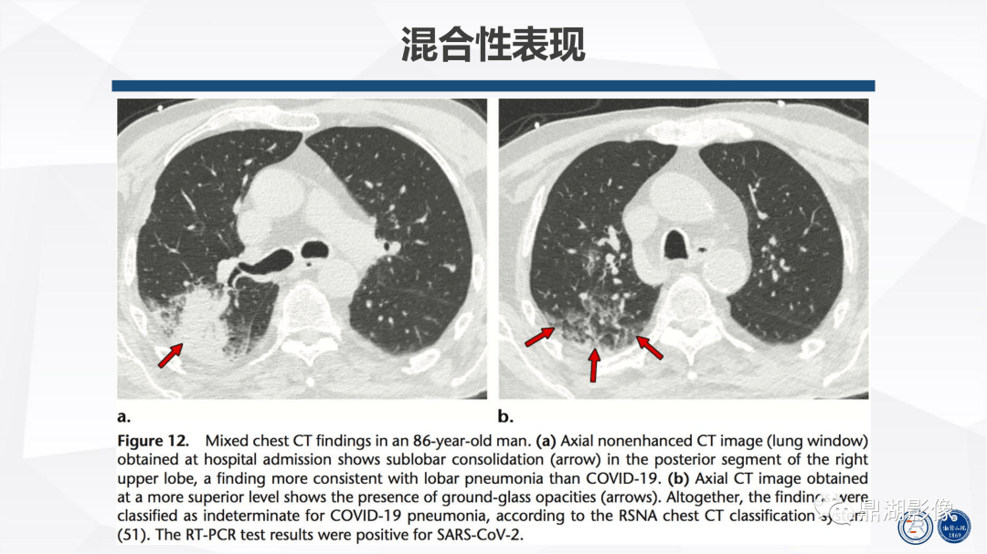 新冠解剖肺部图片图片