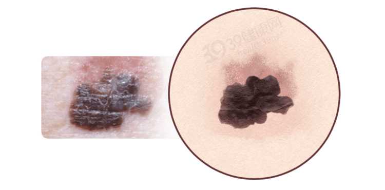 提醒:皮肤出现7种异常,可能是癌症信号_李先生_恶性肿瘤_症状