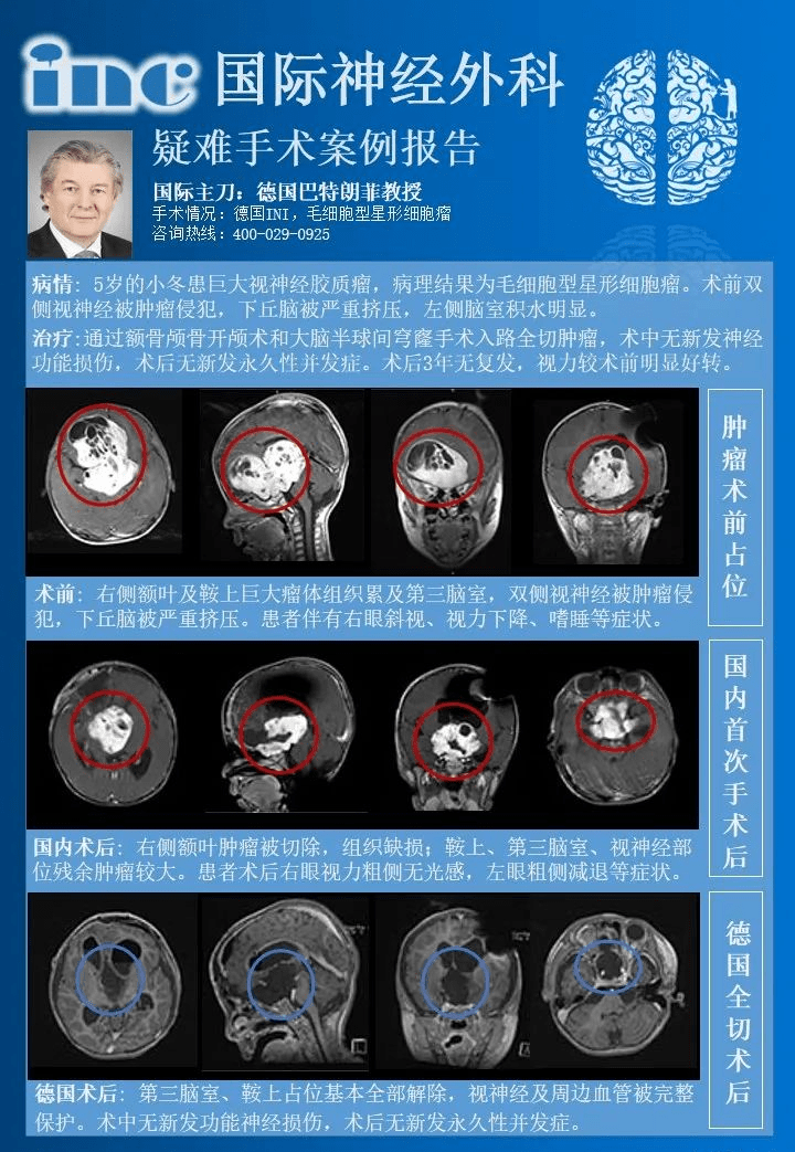 视神经胶质瘤放疗能治好吗？视神经胶质瘤治疗案例分享