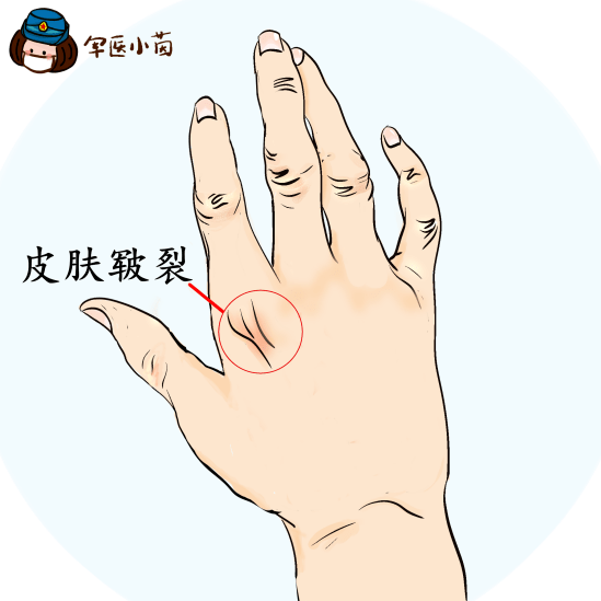 割鱼鳞病遗传鸡皮肤(鸡皮肤鱼鳞病治疗方法)