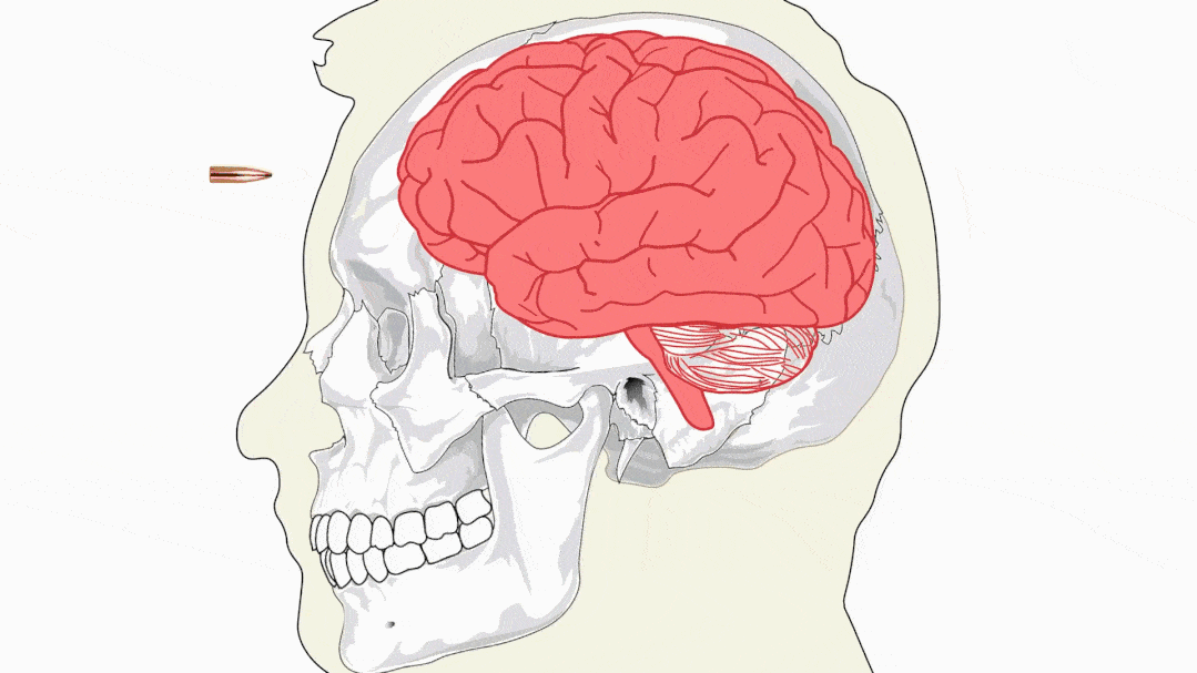 脑子内部到底发生了什么?进来告诉你!_子弹_颅骨_创口