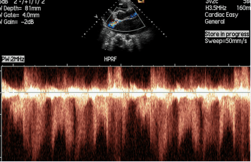 一文掌握:超声心动图必备基本功_诊断_多普勒_分析
