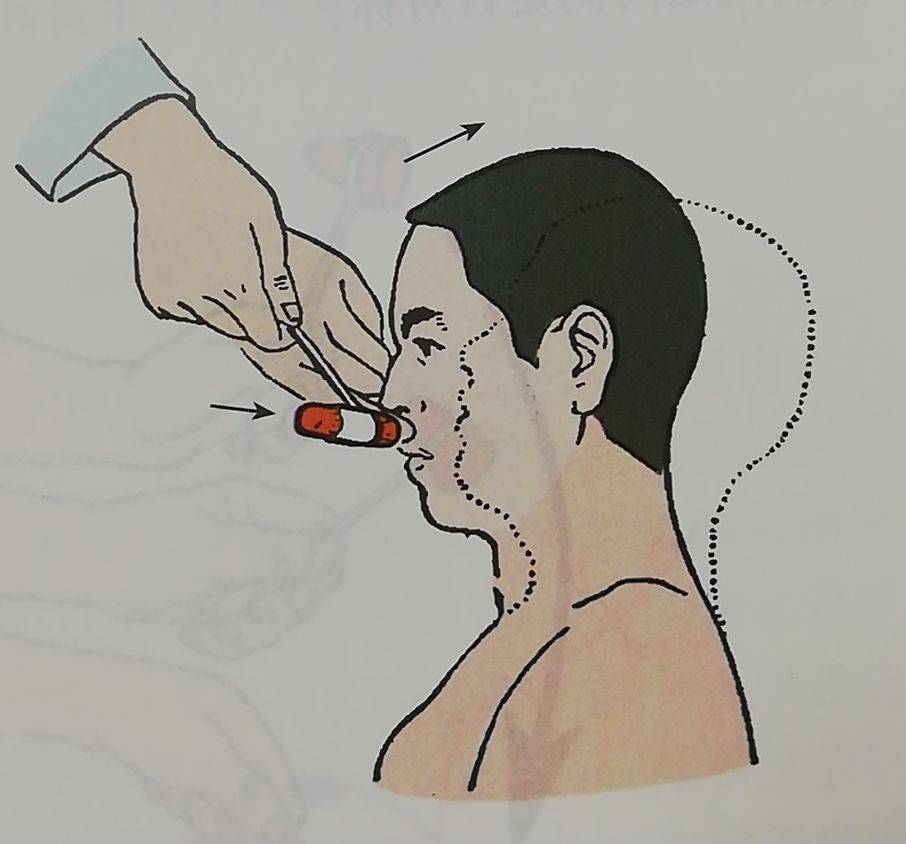 c1-c5,项肌收缩)患者取坐位,头稍前倾,检查者用叩诊锤轻叩上唇中部