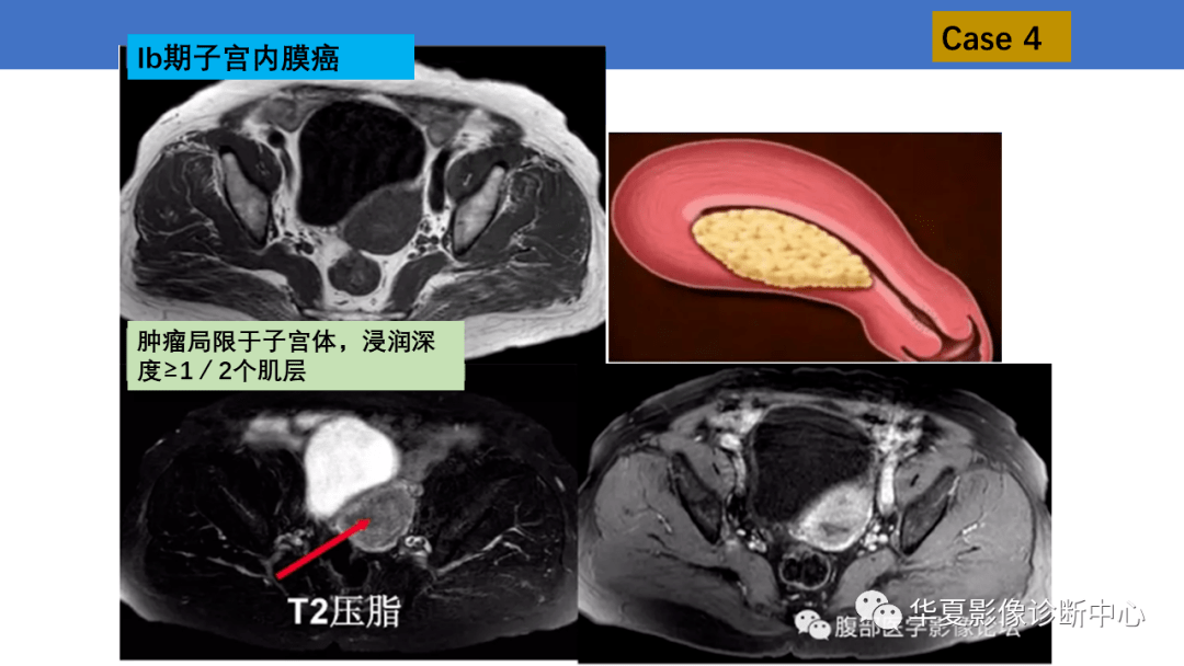 子宫内膜疾病的MRI诊断及鉴别_影像_平台_微信