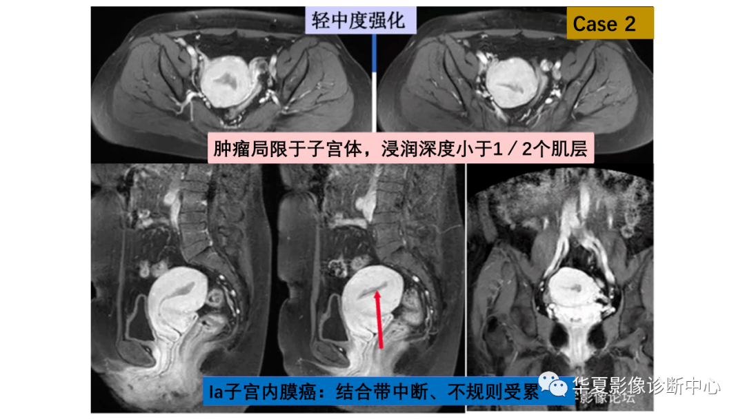 子宫内膜疾病的MRI诊断及鉴别_影像_平台_微信