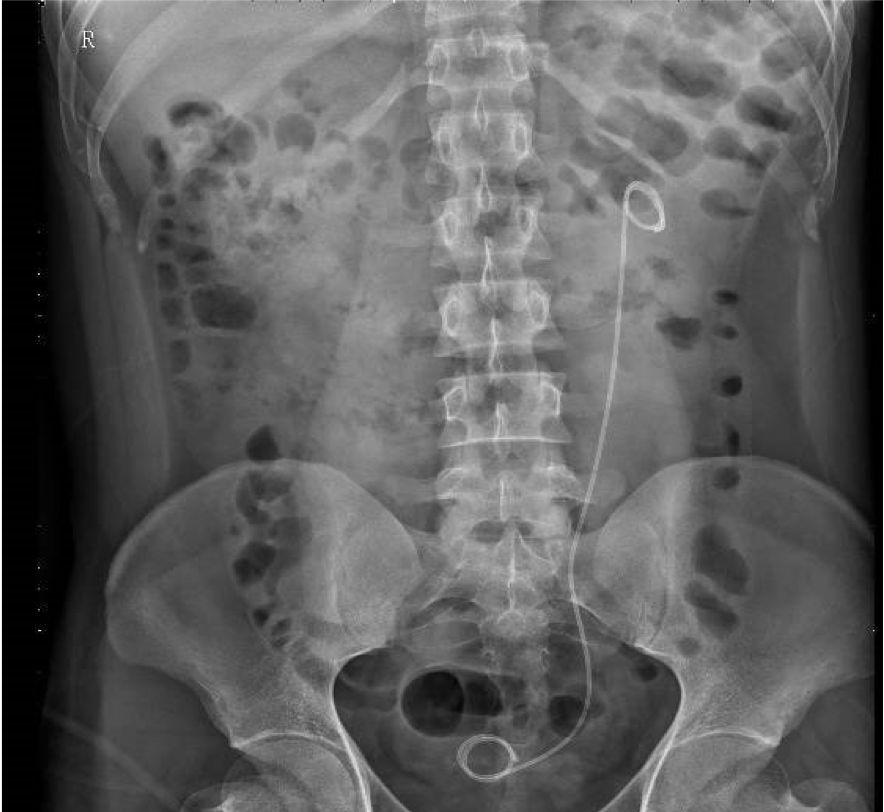 "下水道工人"的利器丨泌尿外科患者不可不知道的dj管硬核知识点_输尿