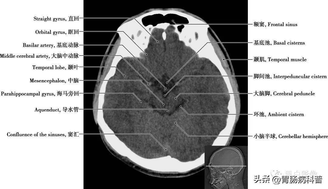 丘脑位置图片ct图片