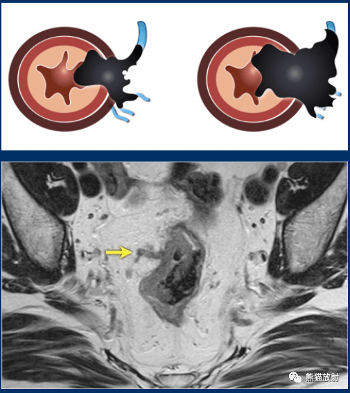 直腸癌mri:精彩示例,易學易懂_括約肌_腸繫膜_腹膜