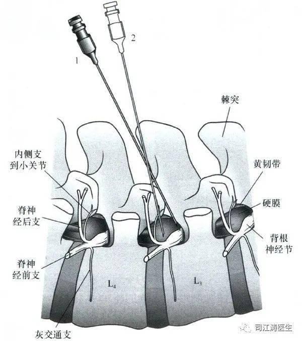 疼痛诊疗|超声引导下腰椎硬膜外阻滞_操作_压迫_间隙