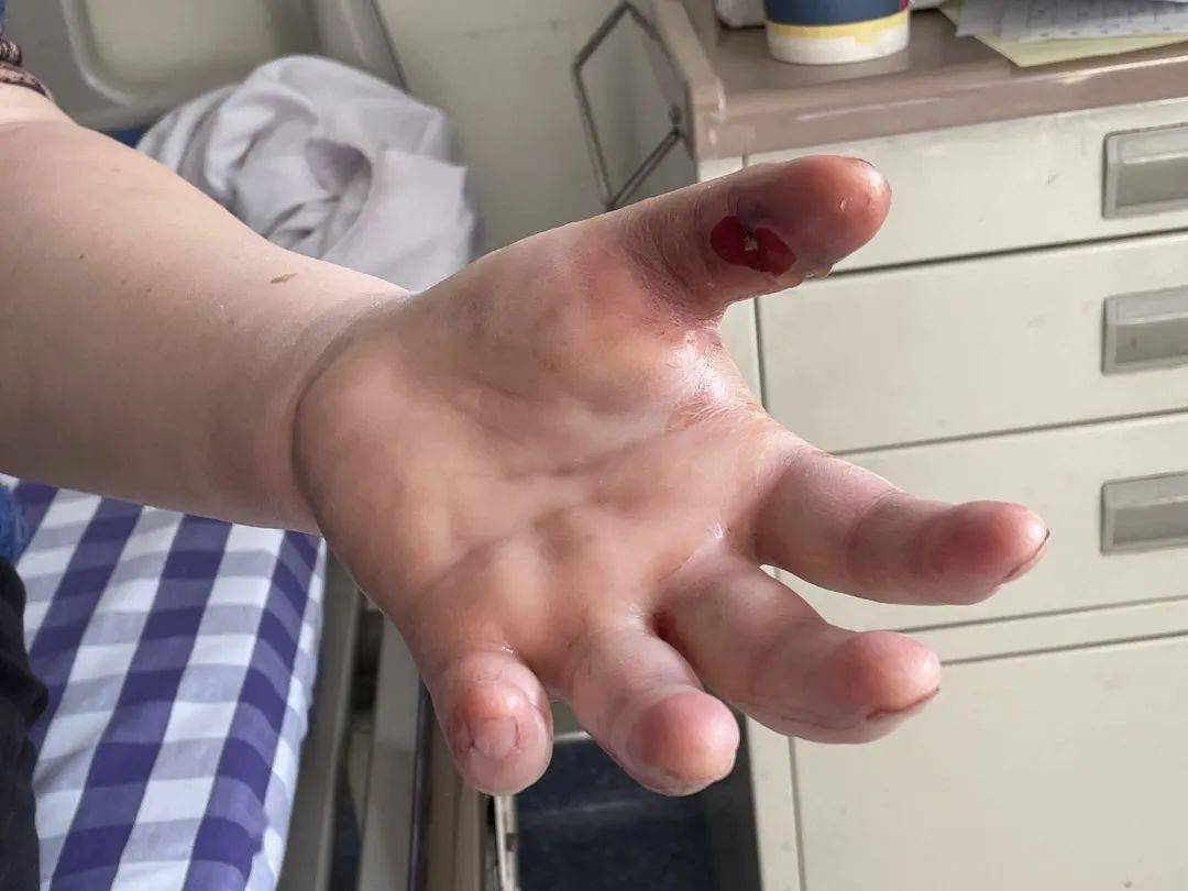 专家所说的海洋分枝杆菌,海洋创伤弧菌等,在海洋动物身上是很常见的