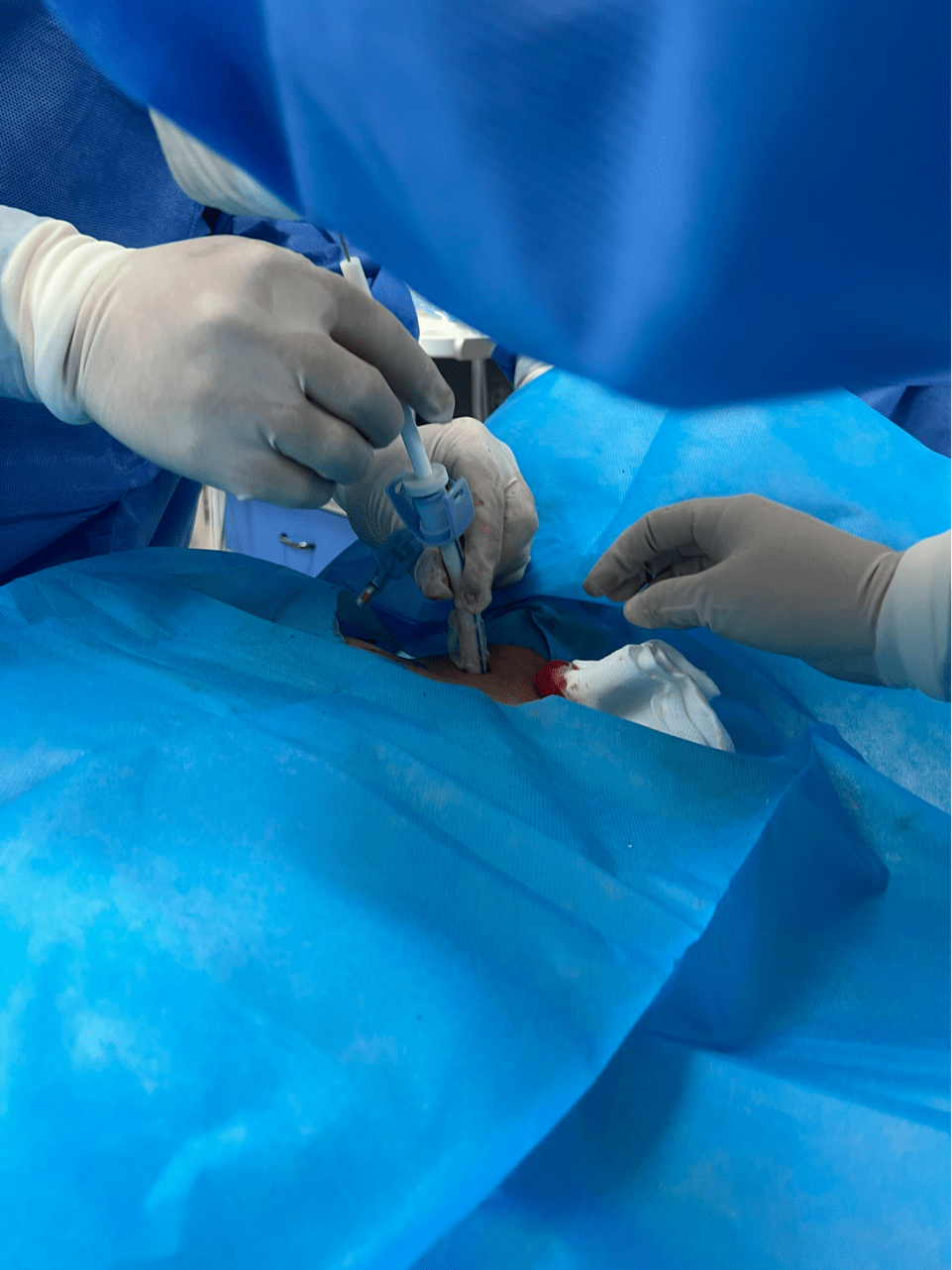 黑龙江省第二医院重症医学科成功开展微创经皮气管切开术_患者_手术