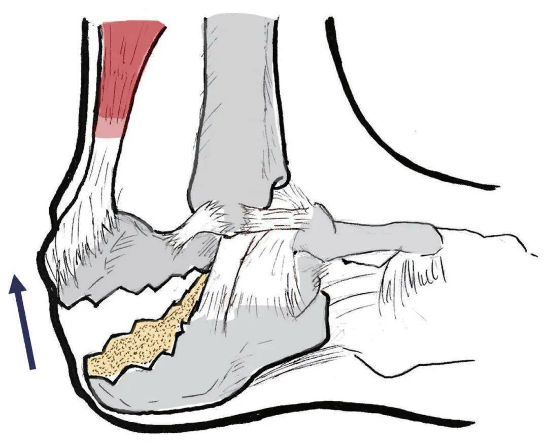 脚跟骨图片 结构图图片