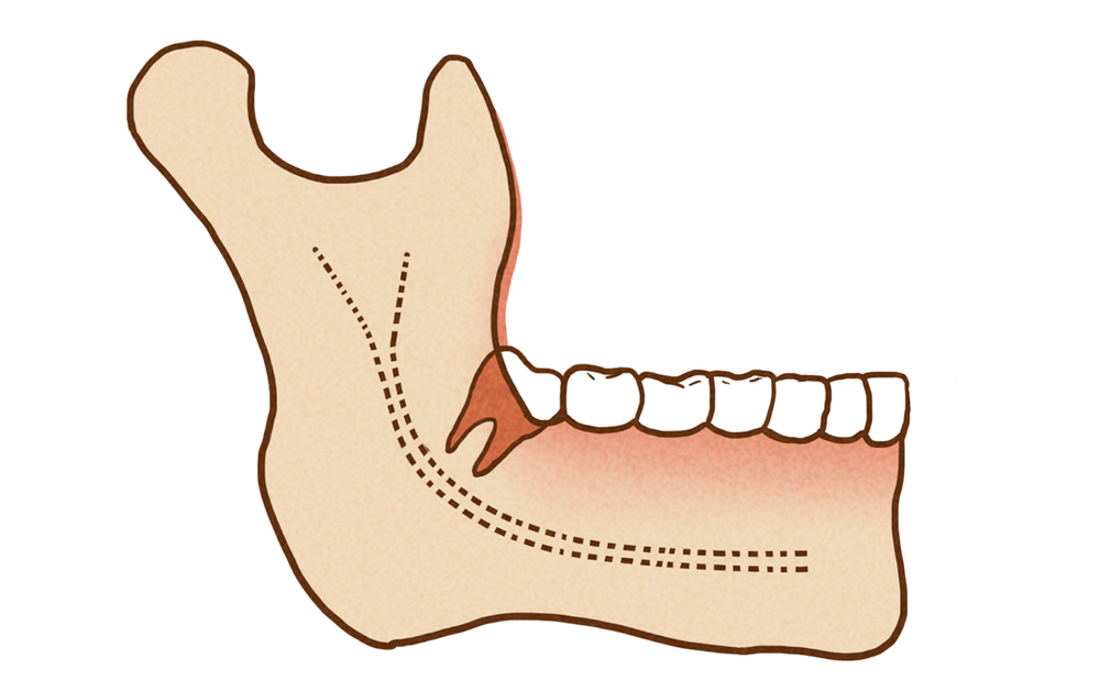 颞下颌关节紊乱,也就是俗称的挂钩出问题了,出现开闭口时疼痛,弹响