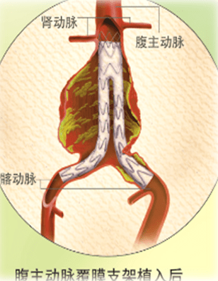 临城县人民医院成功完成首例腹主动脉瘤覆膜支架腔内隔绝术_手术_治疗