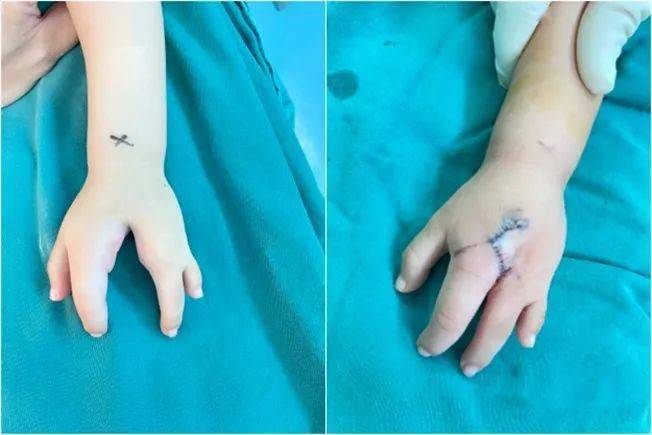 拇内翻畸形,术前术后外观照手足不同类型并指(趾)畸形,术前术后外观