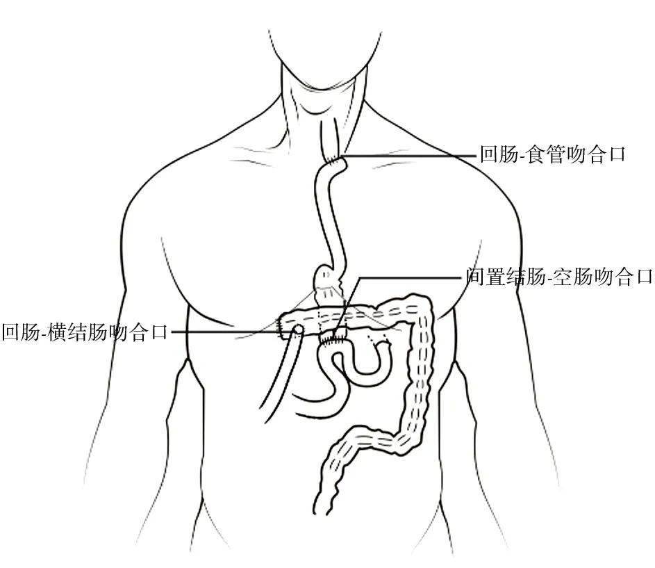 孫益峰等:腔鏡輔助下回結腸代食管術11例|cjts雜誌文章精選_患者_手術