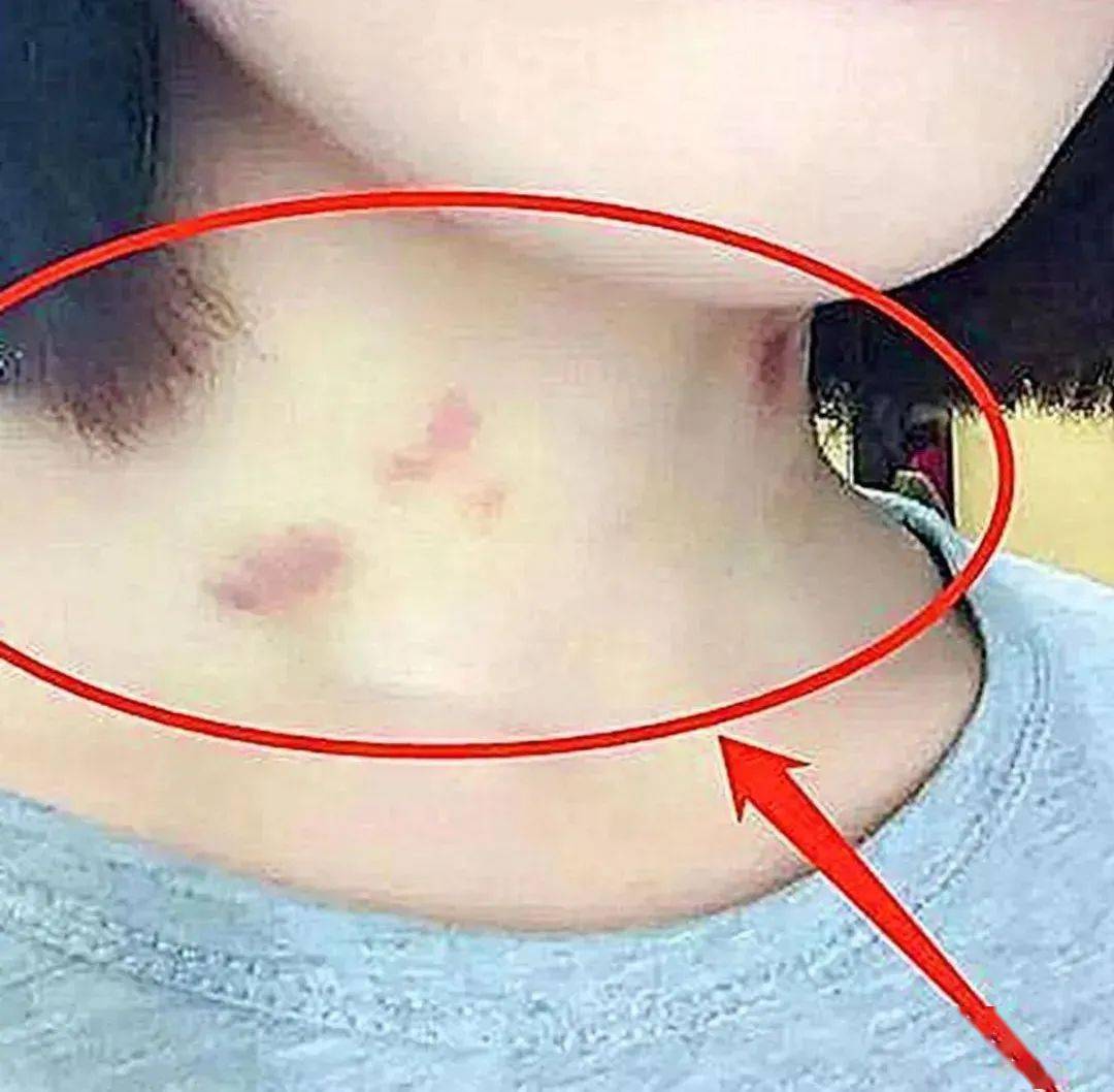 ​初中女生脖子上现"草莓印",父母逼问下说出实情,女儿回答引深思