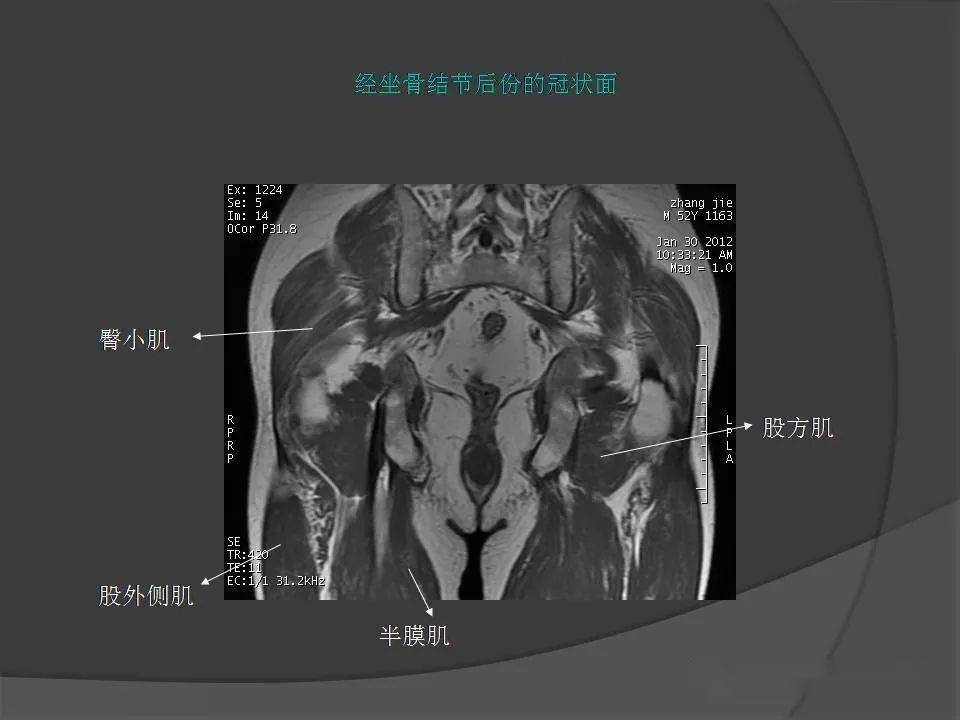 坐骨ct断层解剖图图片