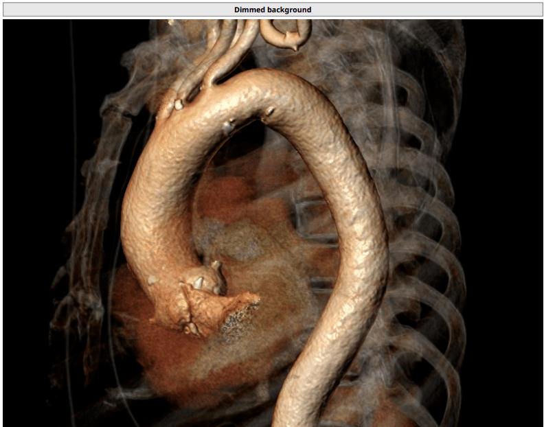 采用极简式方案为80岁患者行tavr手术_钙化_主动脉_瓣膜