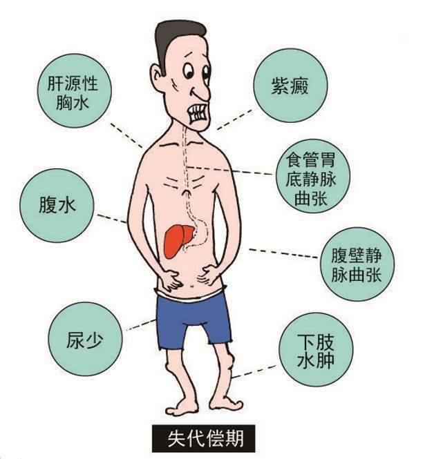 肝源性水肿的特点图片图片