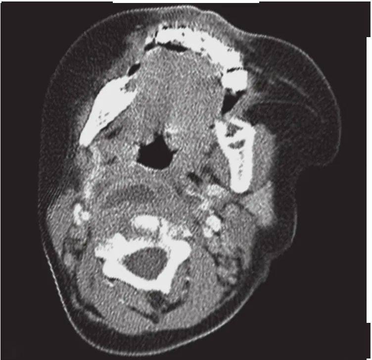 喉部MRI断层解剖图片