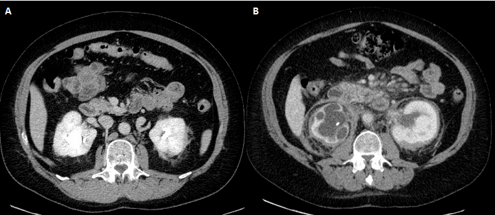 ��ë������������ʶErdheim-Chester ��