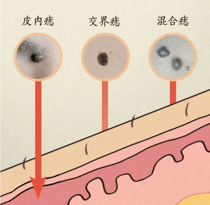 长在这里的痣不要随便点,搞不好会要命!