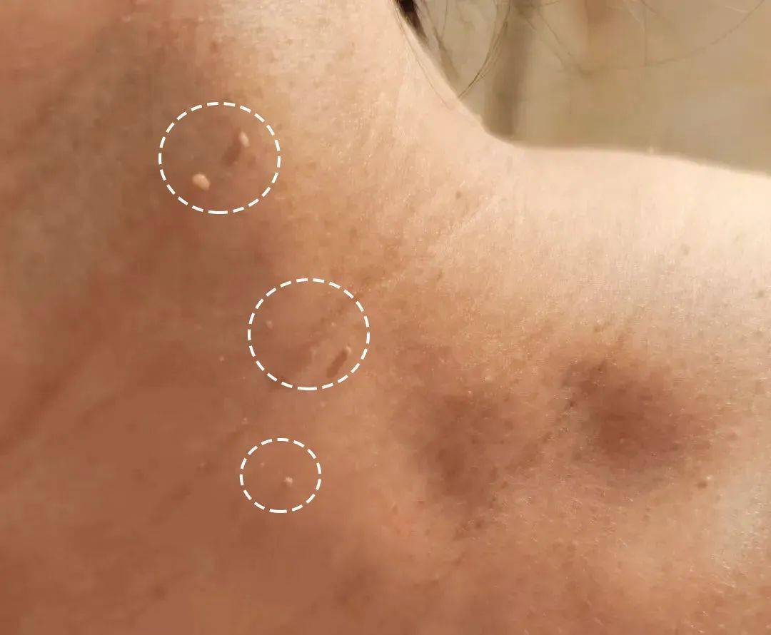 美人姬角质粒软化啫喱