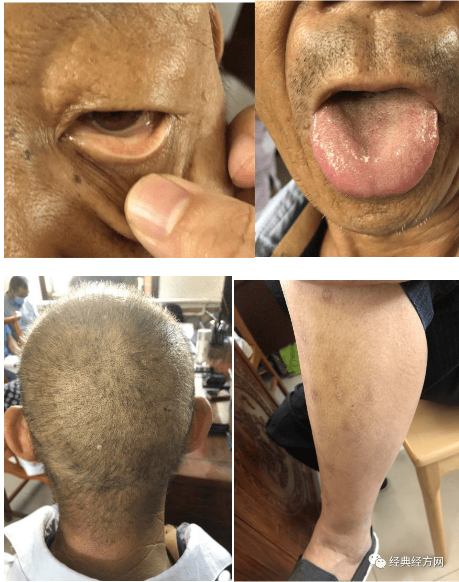 小细胞肺癌患者经典经方治疗三个月临床症状基本消失复查癌肿缩小