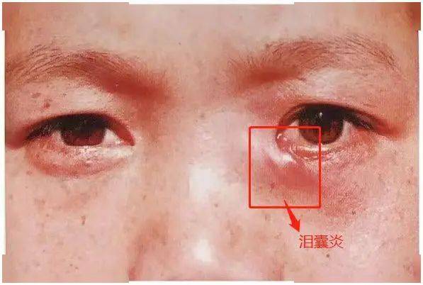 女神眼睛楚楚動人的真相,竟是得了淚囊炎?_淚道_治療_阻塞