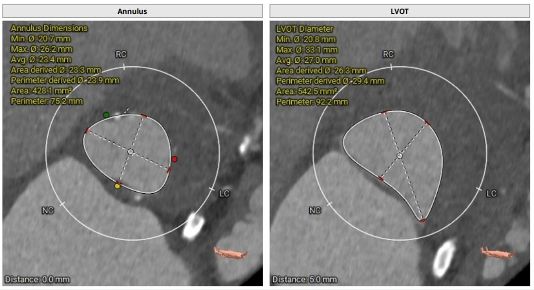 主动脉弓降部走行欠佳,主动脉弓部三根毛开口未见明显狭窄征象,左侧椎