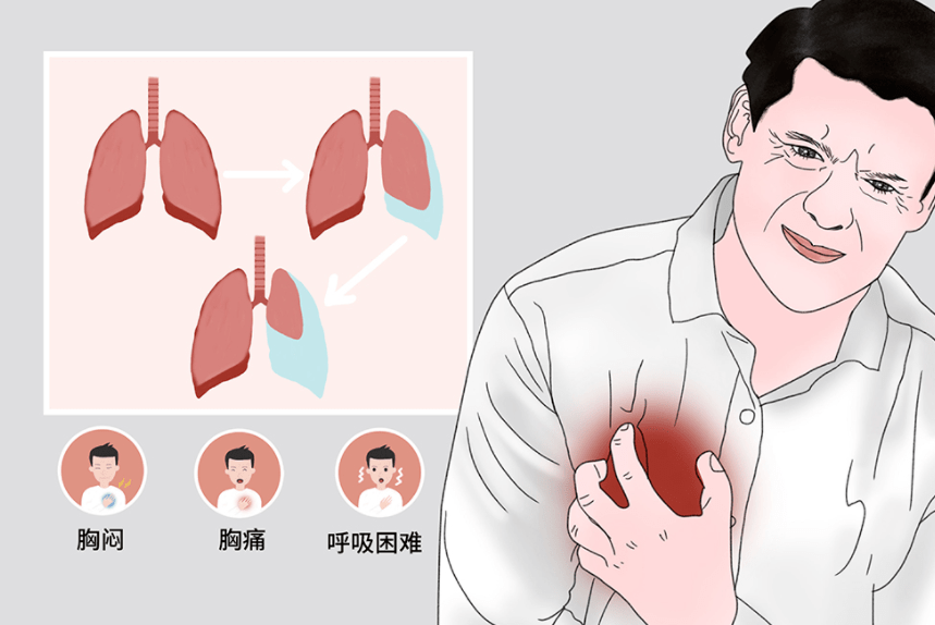 时气体进入胸膜腔,负压消失甚至呈正压,导致肺组织塌陷,肺容积缩小
