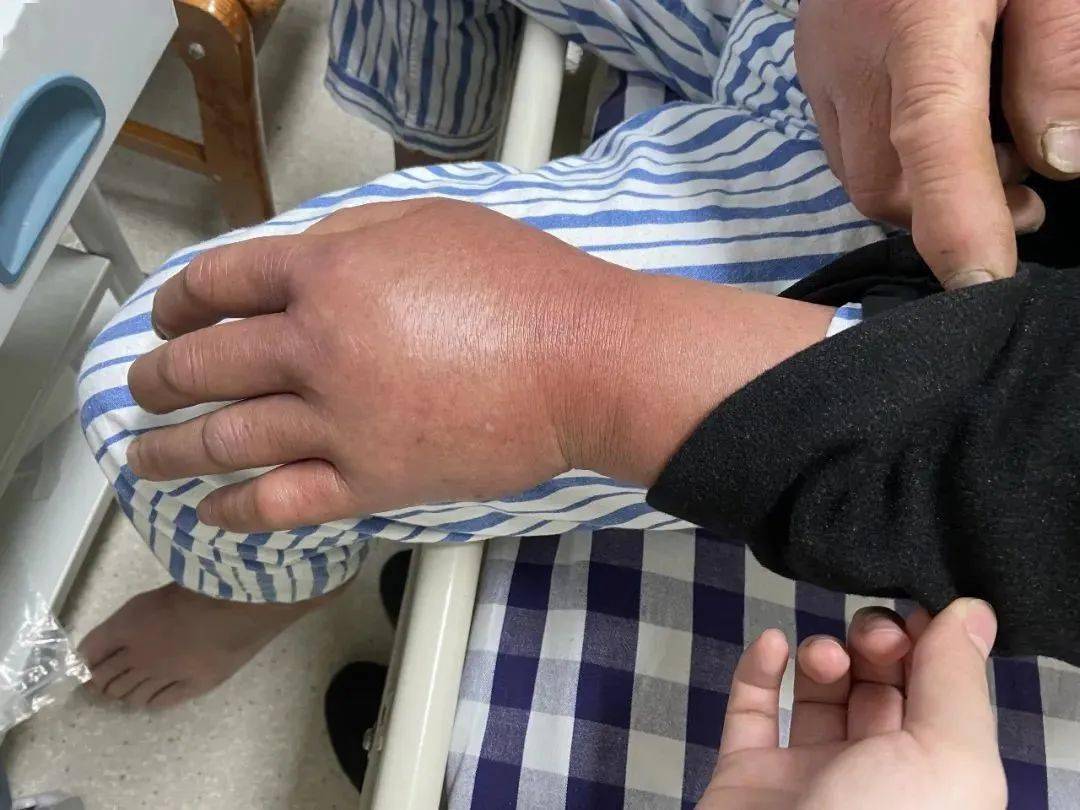 杭州大伯去河边洗了个手,回来左手肿成"馒头"!